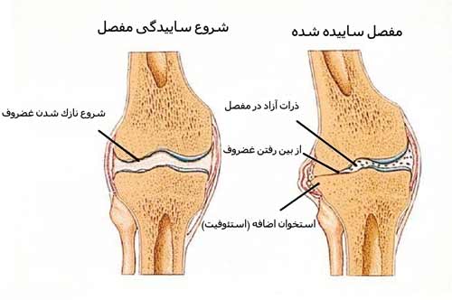 در آرتروز غضروف مفصل بتدریج نازک شده و از بین می رود. استخوان اضافه در اطراف سطح مفصل بوجود میاید