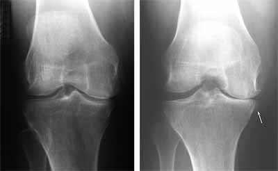 در تصویر سمت راست کاهش فضای مفصلی در یک زانوی ساییده شده دیده میشود و تصویر سمت چپ طبیعی است