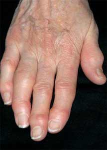 برجستگی سطح پشتی بند انتهایی انگشتان دست از علائم آرتروز است